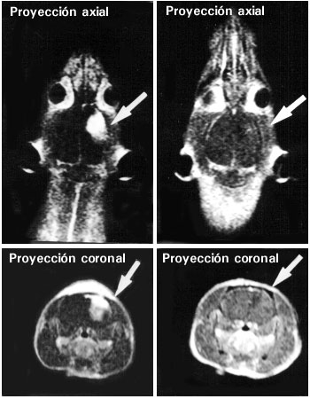 Imagen de resonancia magnética en proyecciones axial y coronal del cerebro de una rata antes (izquierda) y después (derecha) del tratamiento con delta-9-tetrahidrocannabinol durante 7 días. La flecha señala el glioblastoma erradicado.
