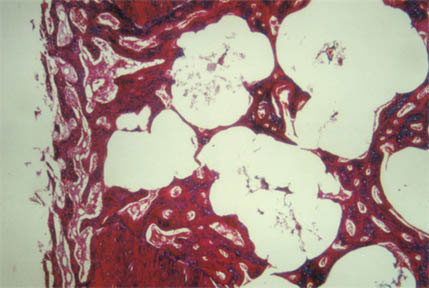 Microscopy study showing biomaterial granules immersed in bone tissue.