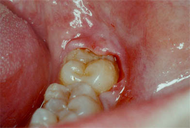 Tercer molar inferior con manifestación infecciosa en forma de pericoronaritis que requerirá tratamiento quirúrgico.