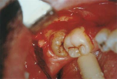 Fase quirúrgica en la que se realiza ostectomía para la liberación del tercer molar inferior.