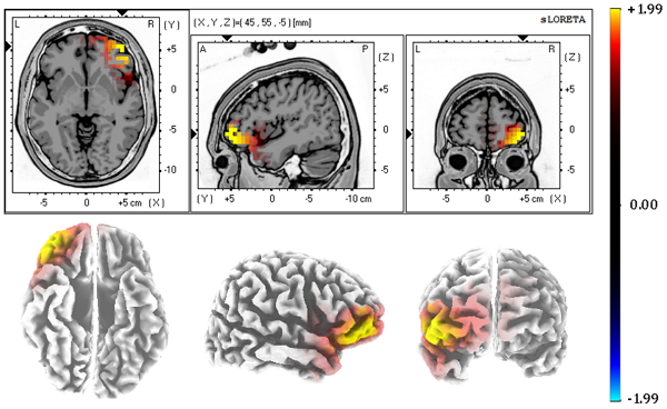 Imagen correspondiente a la localización del origen neural, mediante la aplicación del algoritmo sLORETA, de la actividad EEG registrada en cuero cabelludo.