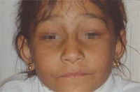 Aspecto facial en una niña con ptosis palpebral y deficiencia visual congénita.