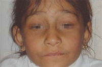 Facial appearance in a girl with palpebral ptosis and congenital visual deficiency.