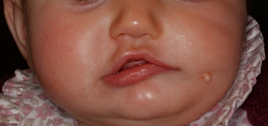 Niña con 10 meses de edad con Síndrome de 1er arco y sus correspondientes secuelas a nivel intraoral y extraoral.
