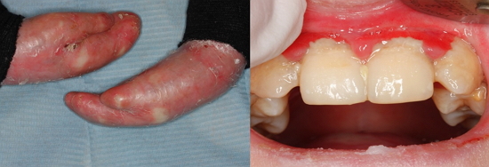 Paciente de 8 años de edad que padece Epidermolisis Bullosa, observesé las secuelas a nivel de manos, así como el estado de salud oral del  paciente.