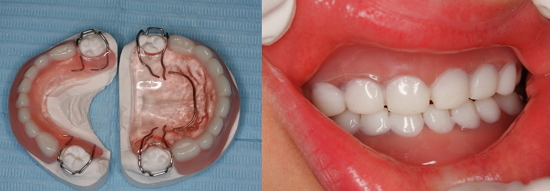 Paciente femenino de 3 años de edad que padece displasia ectodérmica, la falta de dientes prácticamente a la totalidad ha sido sustituida en este caso por sendas prótesis superior e inferior.