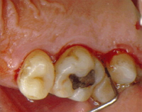 Periodontitis. Se aprecia inflamación de la encía y presencia de bolsas periodontales.