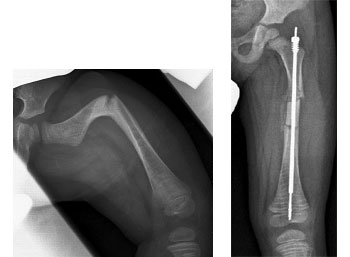 Deformidad y fractura y su corrección quirúrgica en paciente con OI. / Dra Ana Bueno (HU de Getafe).