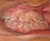 Niño con dentinogénesis imperfecta y  maloclusión clase III. / Joaquín de Nova. 