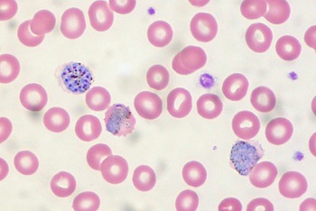Muestra de malaria en sangre. / Ed Uthman.