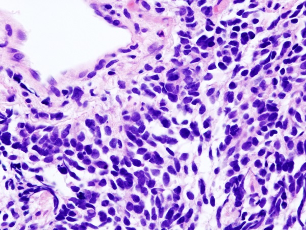 Carcinoma de pulmón de células pequeñas. / KGH.
