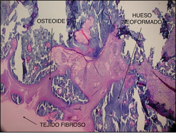 (1). 10% Fe-β-TCP ceramics at 8 weeks with neoformed bony trabeculae and a large osteoblastic forehead.