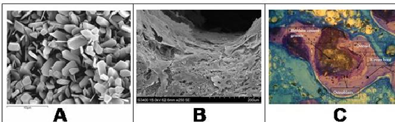 (2) A) Imagen microscópica del cemento de fosfato cálcico constituido por microcristales de brushita. B) Células mesenquimales creciendo dentro de un poro de una matriz porosa de cemento de brushita. C) Regeneración ósea promocionada por un gránulo de cemento de brushita (marrón oscuro) rodeada por una matriz ósea no mineralizada (morado) y hueso inmaduro mineralizado (morado claro) lo cual indica que la formación ósea sigue la reabsorción del gránulo de brushita.