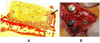 (3) A) Imagen histológica de un bloque 3D de monetita de 4mm de altura, atornillado sobre calota de conejo, a las 4 semanas de su colocación. Se observa neoformación ósea a lo largo de todo el bloque, llegando incluso a la región más superior en el lado derecho (flecha negra). B) Imagen de la calota de un conejo en el momento de la colocación de implantes endoóseos en el interior de los bloques de monetita, demostrando una excelente estabilidad.