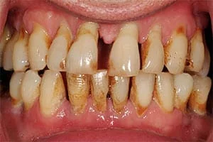 Fig. 1: Paciente con periodontitis. Esta enfermedad puede afectar la masticación, estética y calidad de vida de los pacientes.