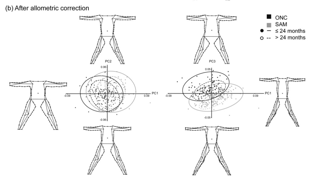 Publicaciones - Severe acute malnutrition morphological patterns in children under five