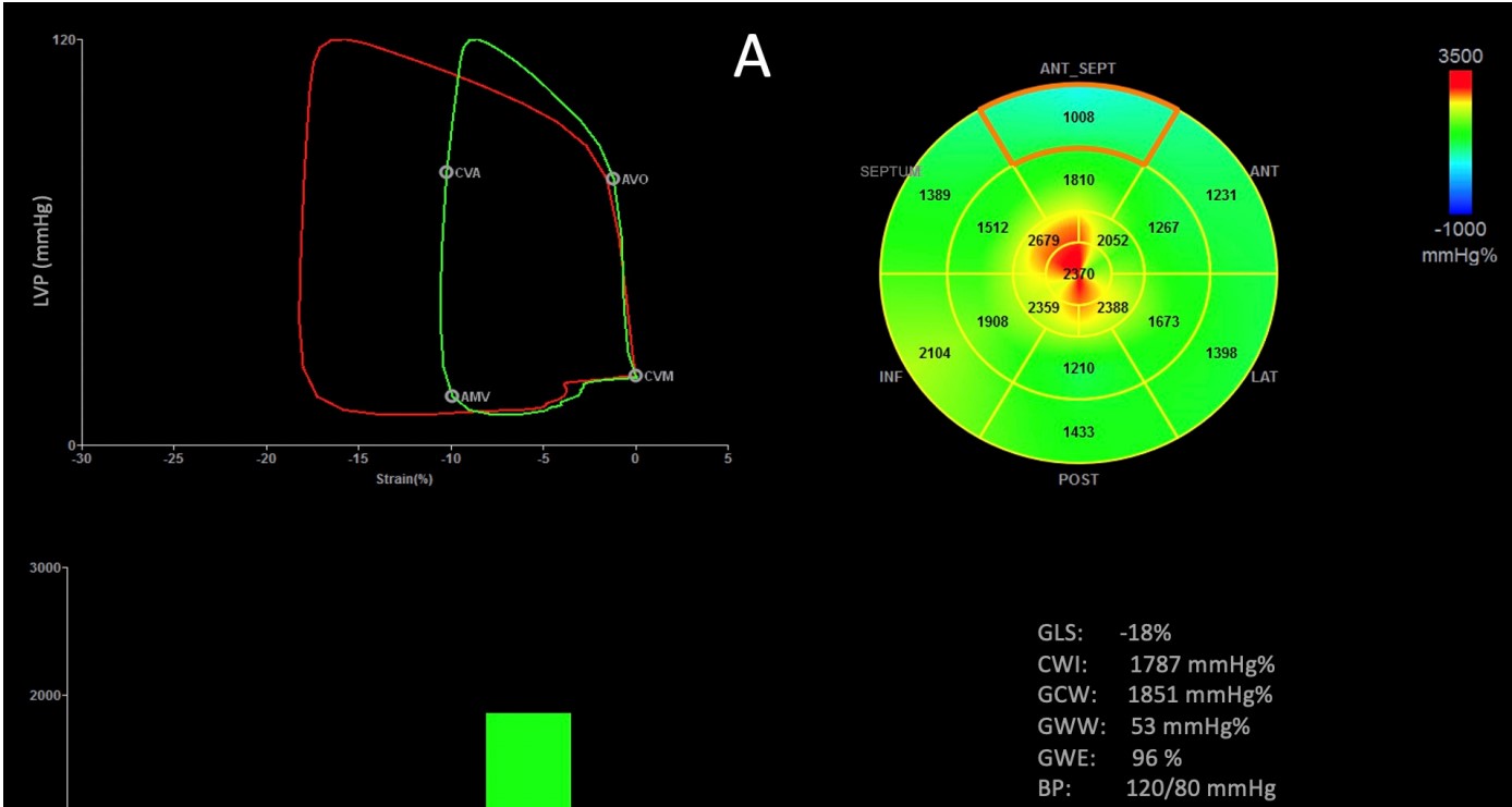 Publicaciones - Myocardial Work Index in professional football players for assessment of cardiac adaptation