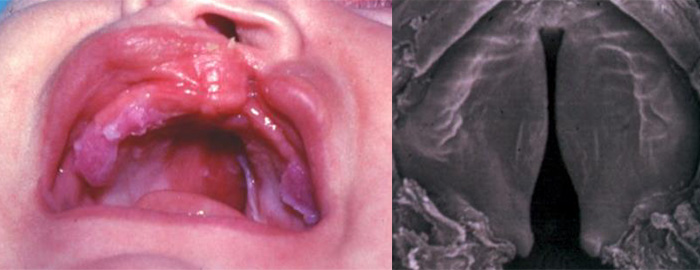 Investigación en Desarrollo del Paladar y Fisura Palatina