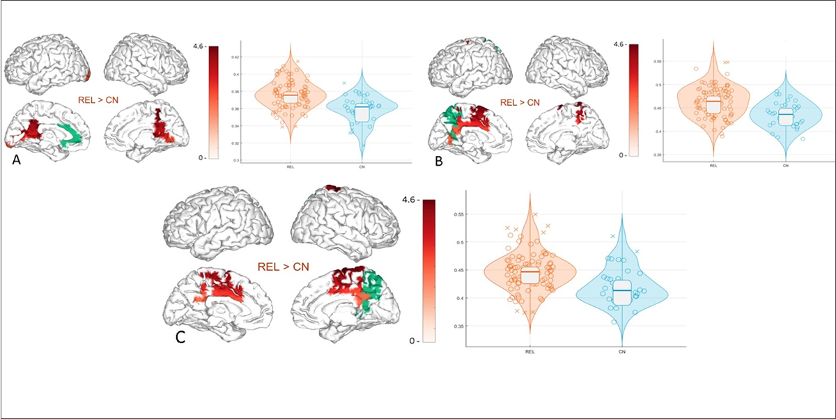 Familiares de pacientes con Alzhéimer muestran diferencias en las redes funcionales del cerebro décadas antes de la aparición de síntomas clínicos