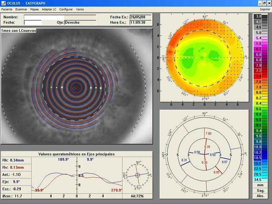 Mapa topográfico corneal