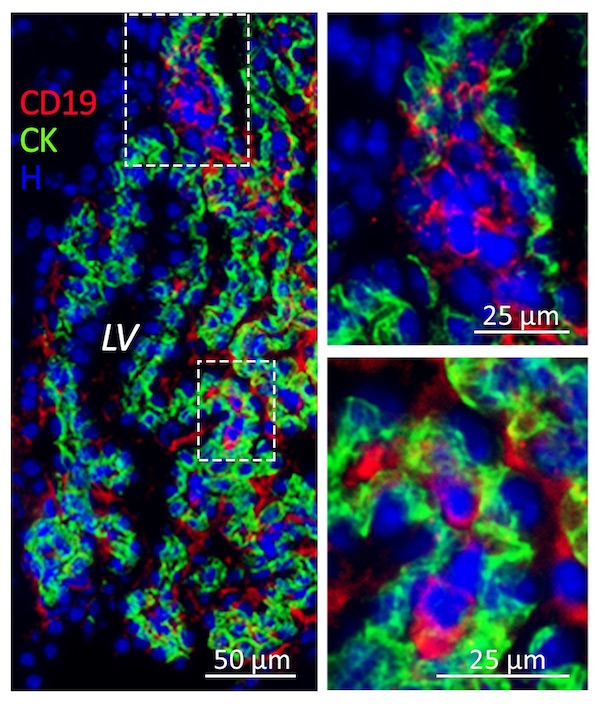 Los investigadores utilizaron técnicas de inmunofluorescencia y microscopía electrónica para la localización cerebral de las células tumorales en ratones. / J. Pathol. 
