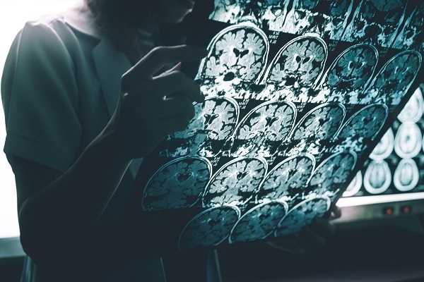 Conocer la evolución del alzhéimer desde sus etapas más tempranas es uno de los retos de la ciencia. / Shutterstock. 