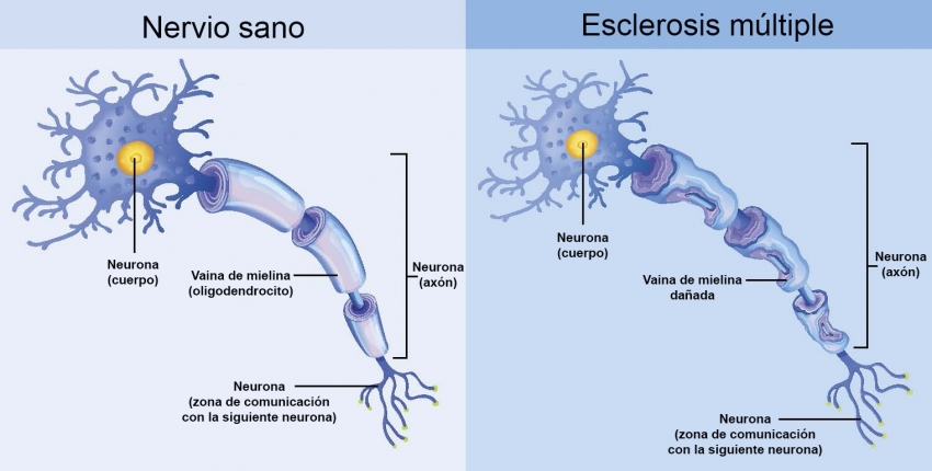 Comparación entre un nervio sano y otro con daño en la mielina por esclerosis múltiple. / Shutterstock. 